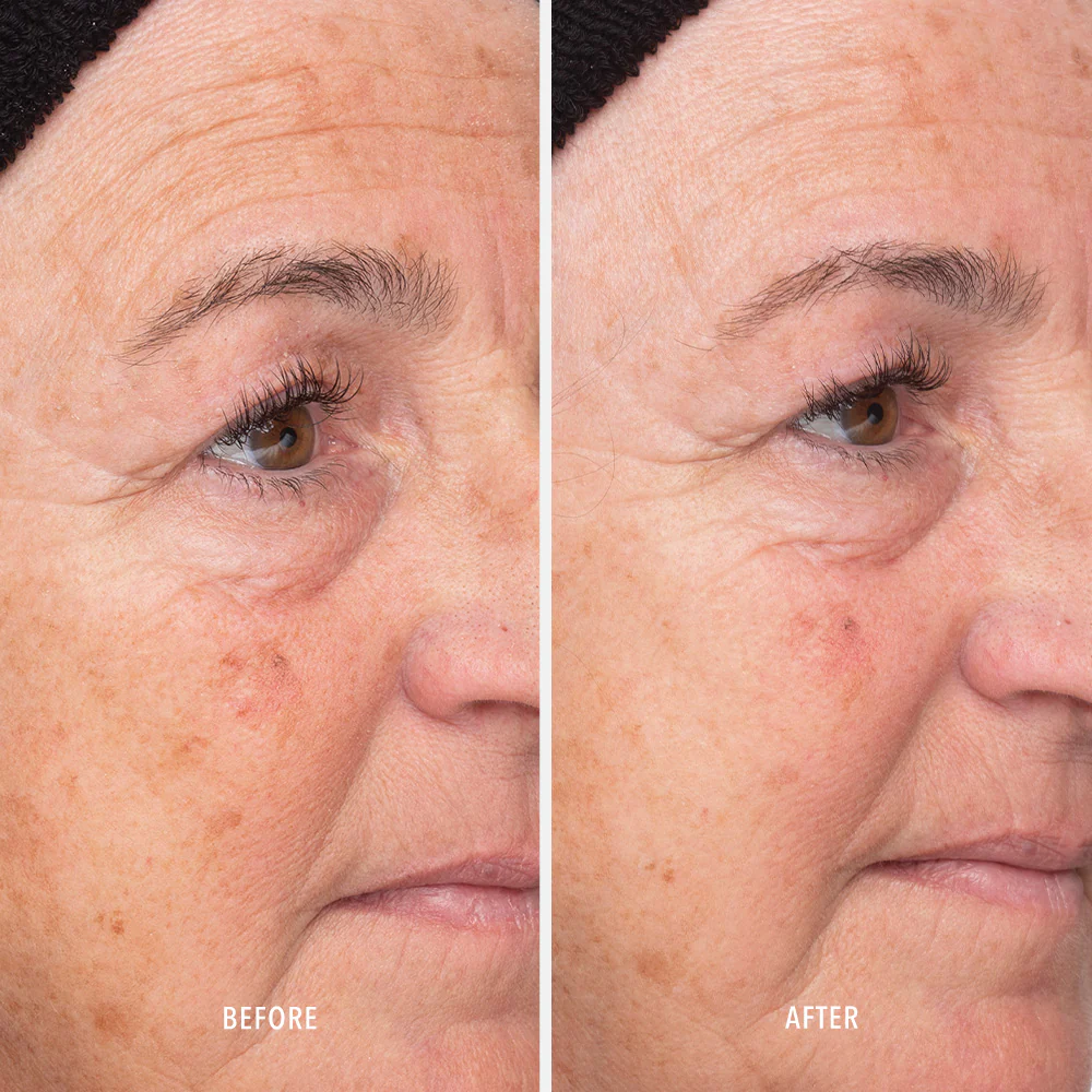 LIQUID RESURFACING SOLUTION – Soluție Exfoliantă Lichidă 120 ml - imagine 4